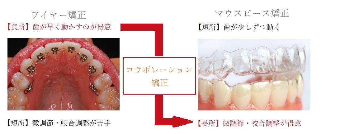コラボ矯正の説明