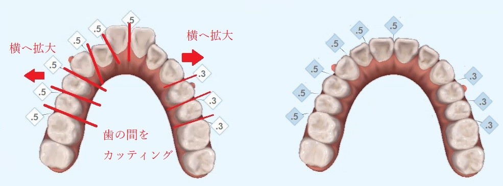 八重歯の歯並びシミュレーション