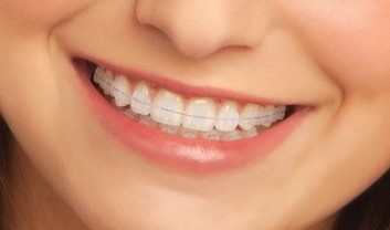 表側矯正のワイヤー