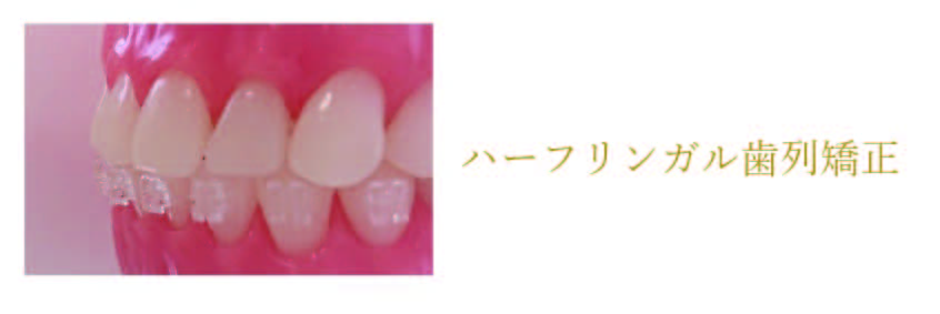 ハーフリンガル歯列矯正 詳しくはこちら