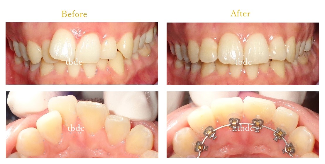 前歯だけの部分矯正 | 東京ビアンコ歯科/矯正歯科(東京ビアンコ・デンタルクリニック)-新宿院
