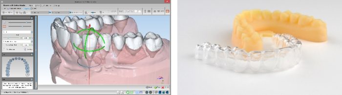 ３Ｄデジタル・マウスピース矯正イメージ