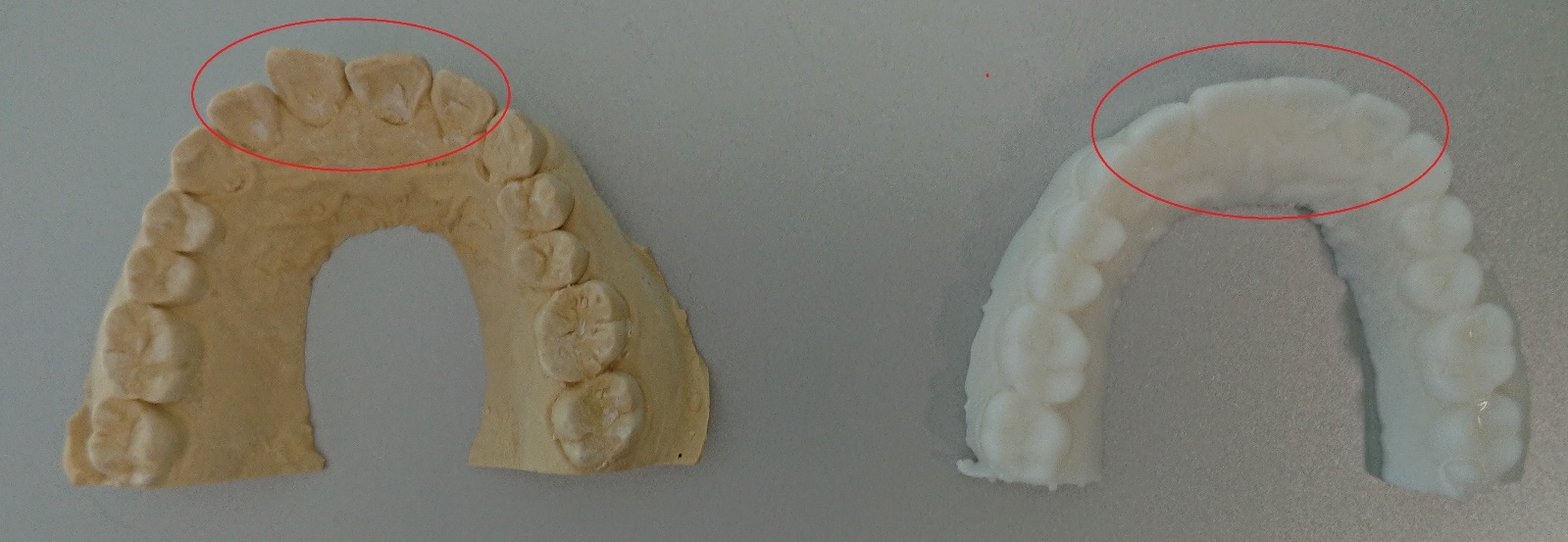 歯型をスキャナーで3Dデータ化したイメージ画