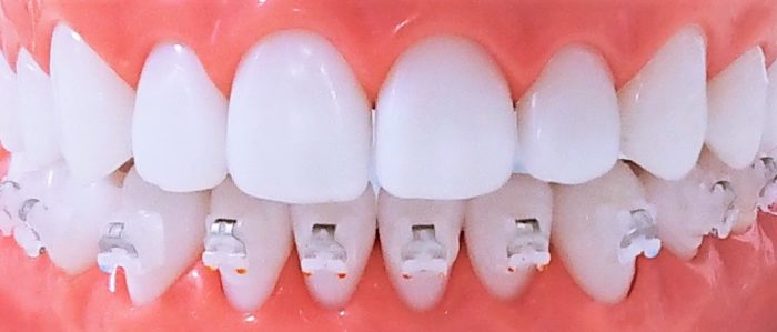 歯の動きがスムーズで確実なクリップタイプも選べます
